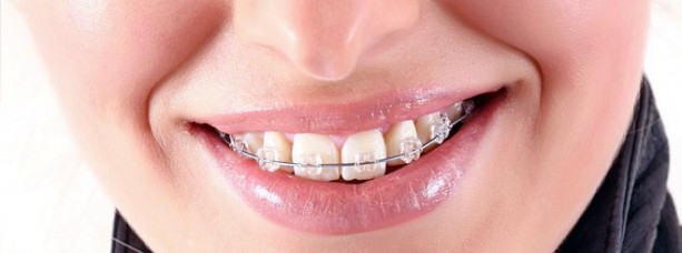 Как носить и ухаживать за ортодонтическими конструкциями?