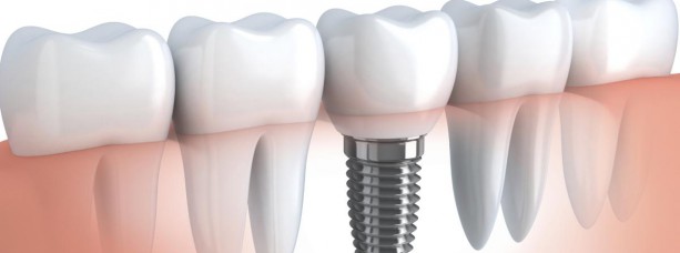 Имплантация зубов. Показания и противопоказания для процедуры