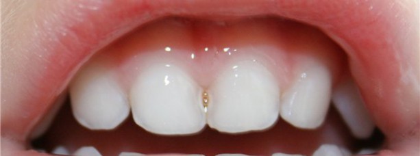 Процесс серебрения молочных зубов