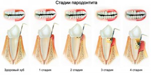 Кюретаж в стоматологии