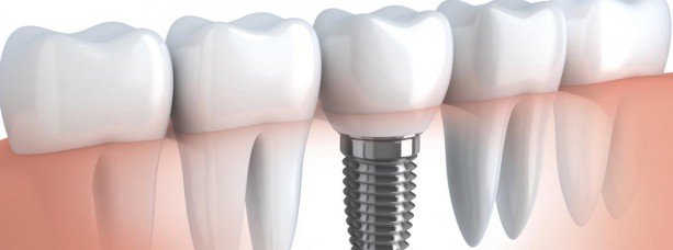 Имплантация зубов. Показания и противопоказания для процедуры