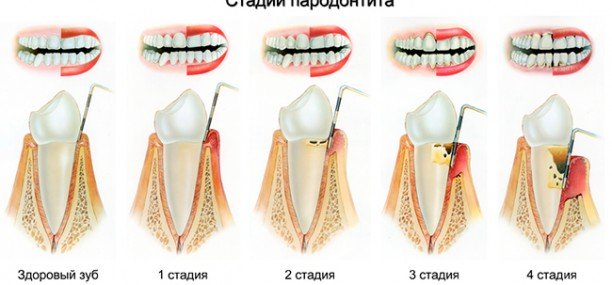 Кюретаж в стоматологии