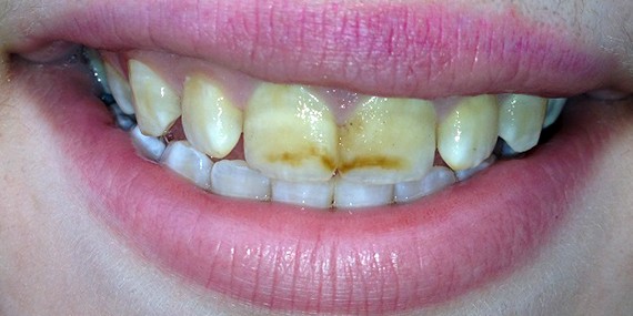 Флюороз зубов и его лечение