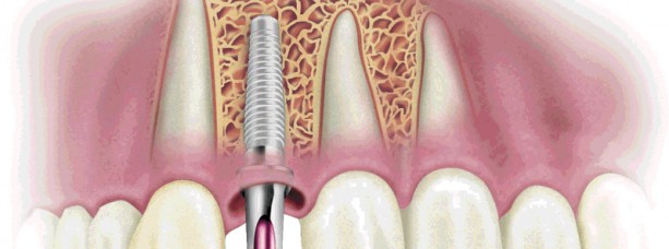 Одноэтапная имплантация зубов