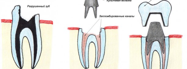 Что необходимо знать о искусственных коронках?