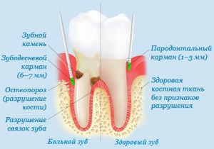 Кюретаж в стоматологии и зачем это?