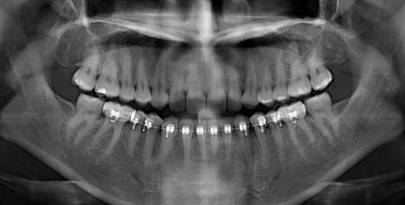 Панорамный снимок зубов перед протезированием