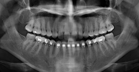 Панорамный снимок зубов перед протезированием