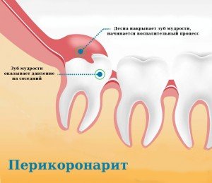 Каким образом лечить перикоронарит?