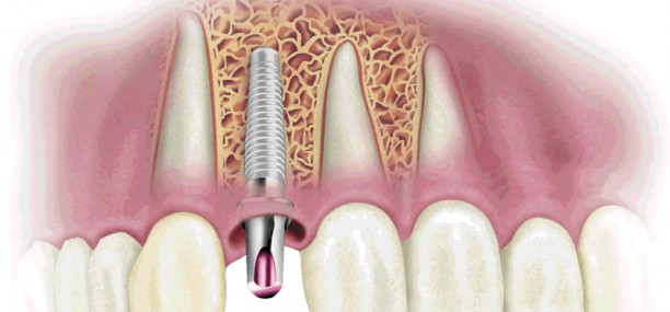 Одноэтапная имплантация зубов