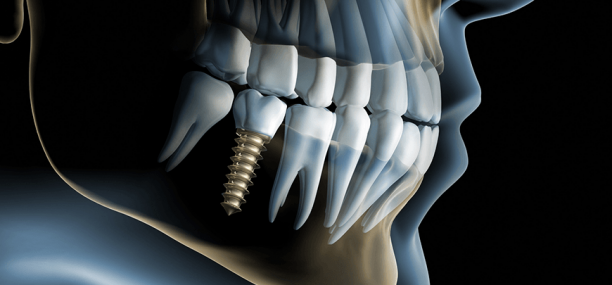 Базальная имплантация зубов и преимущества