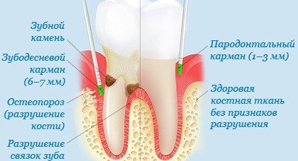 Кюретаж в стоматологии и зачем это?